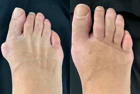 Bunion Surgery Before and After | Northwest Surgery Center Wisconsin