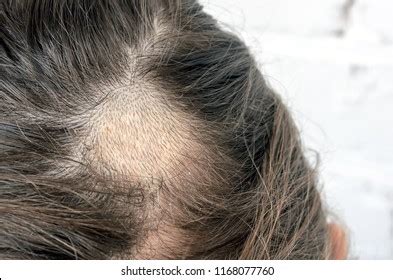 643 Parasites The Scalp Images, Stock Photos & Vectors | Shutterstock