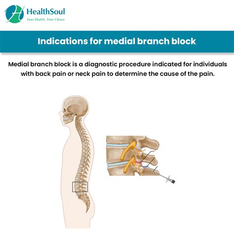 Medial Branch Block: Indications and Complications – Healthsoul