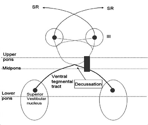 Upward vestibulo-ocular reflex pathway. Left unilateral pontine lesion... | Download Scientific ...