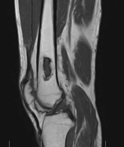 Enchondroma-MRI - Sumer's Radiology Blog