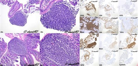 Follicular Lymphoma Pathology Outlines