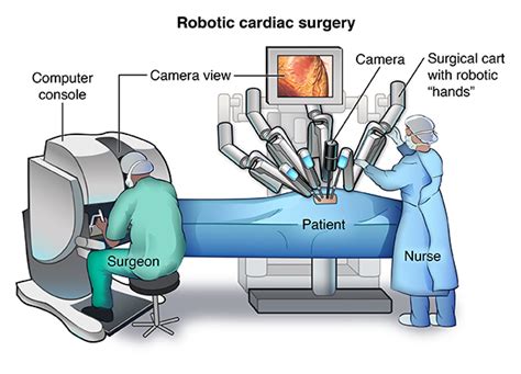 Robotic Cardiac Surgery - Health Encyclopedia - University of Rochester Medical Center