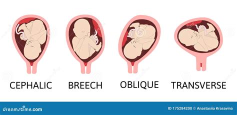 Verschillende Babyposities Tijdens De Zwangerschap. Doorsnede Schuine ...