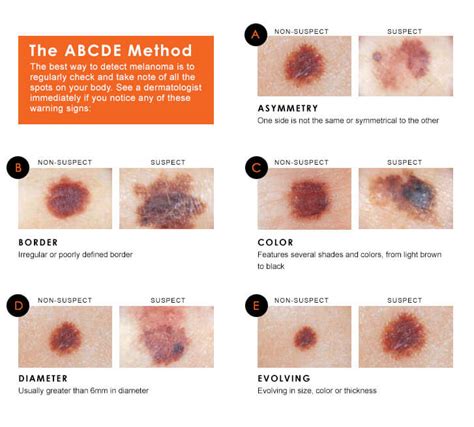 Melanoma Signs And Symptoms - Doctor Heck