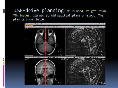 CSF flow study | PPT