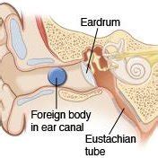 Parameter definition of anomalies that change the section of the ear canal | Download Scientific ...