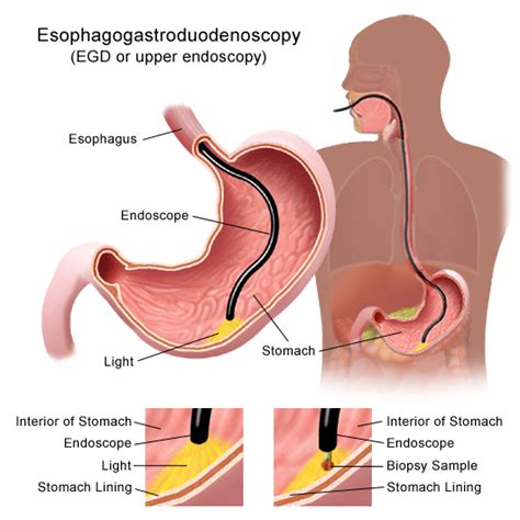 Upper Endoscopy Procedure