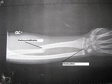 Galeazzi fracture, X-ray - DocCheck