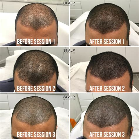 Scalp Micropigmentation SMP for Long Hair in Birmingham UK | Results & Process