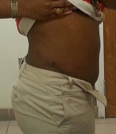 Mini tummy tuck pictures before and after Houston surgeons pics » Tummy Tuck: Prices, Photos ...