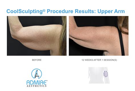 CoolSculpting Elite Results