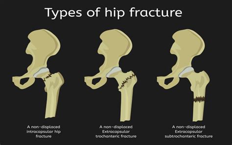 Hip Archives - Comprehensive Orthopaedics