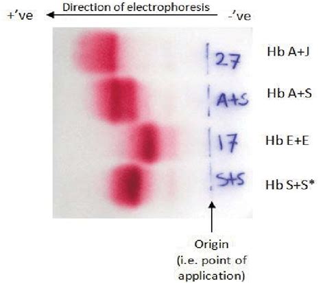 Hemoglobin electrophoresis for sample # 17 and 27. Known A+S sample was ...