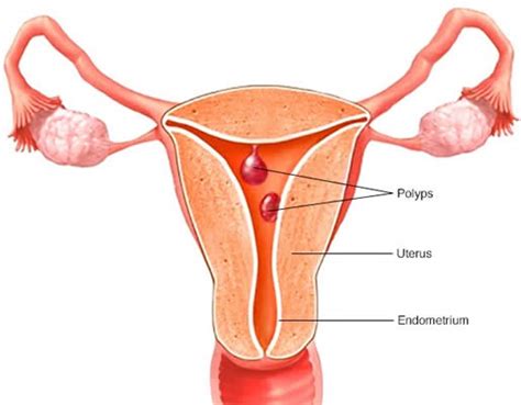 Minimally Invasive Surgery : Transcervical Resection of Endometrial Polyps