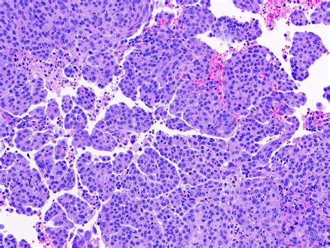 Pathology Outlines - Serous carcinoma