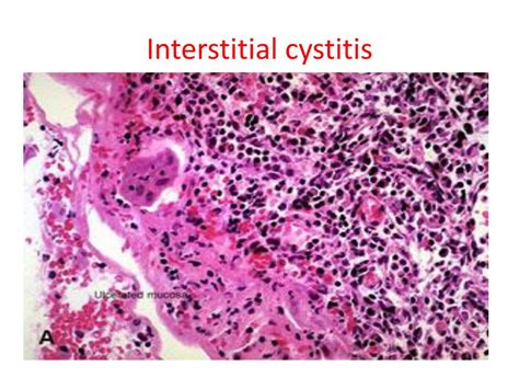 PPT - Interstitial cystitis PowerPoint Presentation, free download - ID:1917026