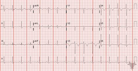 Right Heart Strain | ECG Stampede