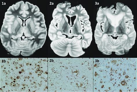 Examples of patients with vCJD, sCJD and non-CJD diagnoses. Axial ...