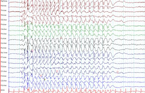 Frontiers | Electroencephalography in the Diagnosis of Genetic Generalized Epilepsy Syndromes