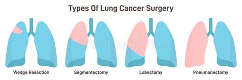 Lungs Cancer Surgery Types. Wedge Resection, Segmentectomy Stock Vector - Illustration of tumor ...