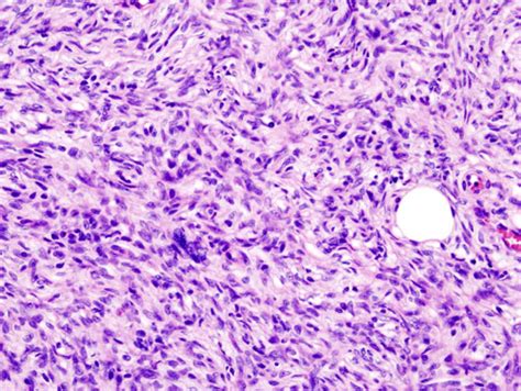 Dermatofibrosarcoma Protuberans Histology