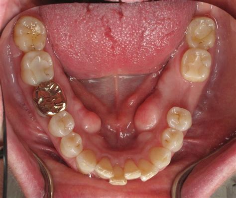 Socket Bone Grafting for Dental Implants | Ramsey A. Amin, DDS