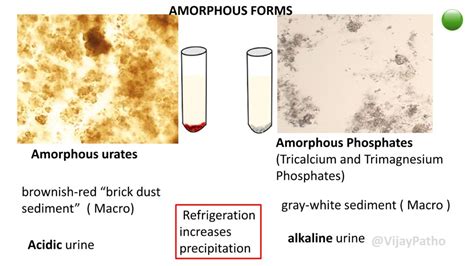 Amorphous Phosphate Crystals In Urine