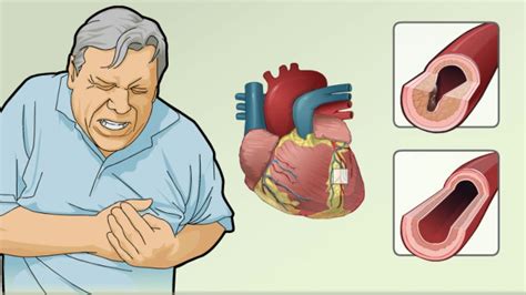 How Does Coronary Artery Disease Kill You - Gallery