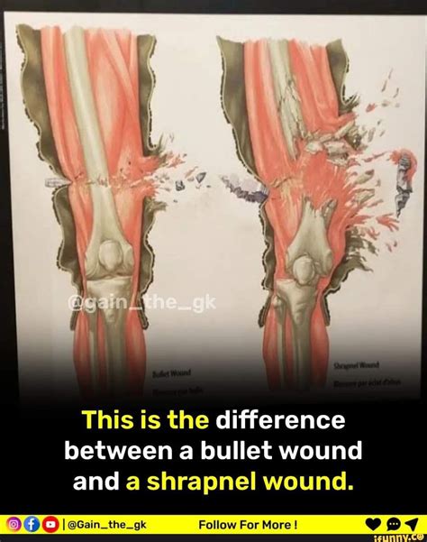 This is the difference between a bullet wound and a shrapnel wound. Fa PAI tho aL ECalinuw Dar ...