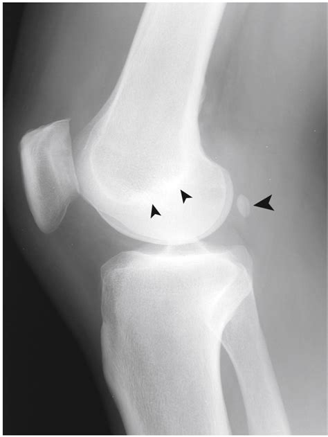 Adductor Tubercle X Ray