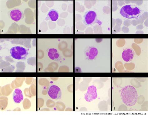 Peripheral smear in COVID 19: a case report | Hematology, Transfusion ...