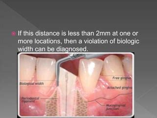 Biologic width - Importance in Periodontal and Restorative Dentistry