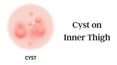 Cyst On Inner Thigh: 5 Best Home Remedies