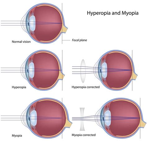 > Myopia is the term used to define being shortsighted. A myopic person ...