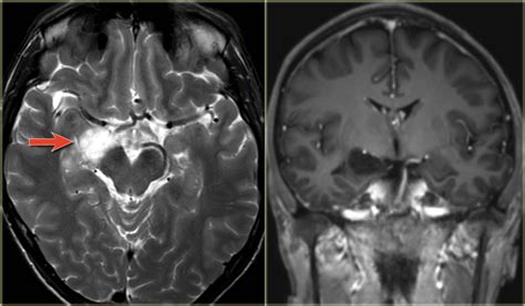 The Radiology Assistant : Brain - Epilepsy: Role of MRI