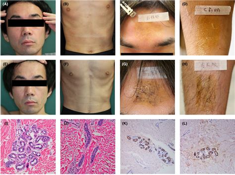 A case of atopic dermatitis with hypohidrosis improved after dupilumab ...