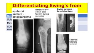 Osteogenic Sarcoma Sunburst