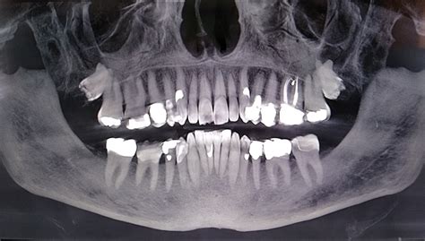 Dental X-ray – Bill and Paul's Excellent Photograph-a-Week Adventure