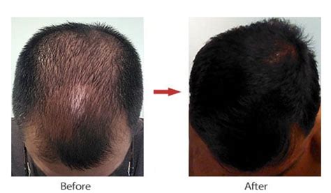 Hair Restoration Before and After Gallery - Laser Cap Me