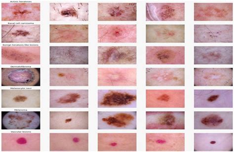 Stages of skin cancer | Download Scientific Diagram