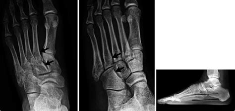 Normal radiographic parameters of the Lisfranc joint on anteroposterior ...