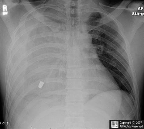 Hemothorax. Causes, symptoms, treatment Hemothorax