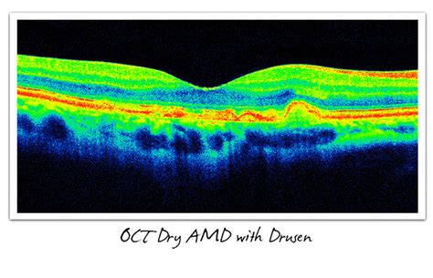 Dry & Wet AMD - Signs, Symptoms, and Diagnosis - Cure AMD Foundation