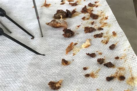 Expert removes 16 years worth of built-up ear wax in man's ear