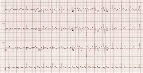 Wellens Syndrome • LITFL • ECG Library Eponym