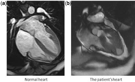 Cardiac cine MRI. (a) Systolic phase of normal heart. (b) Systolic ...