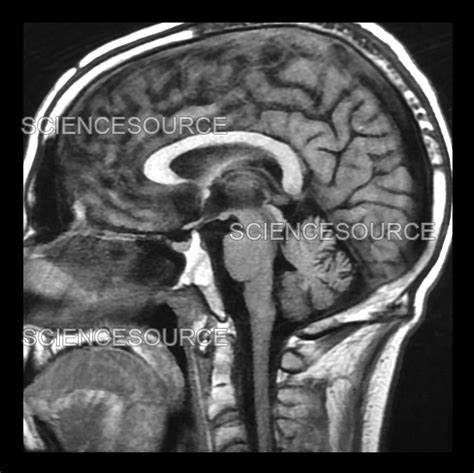 Wernicke-Korsakoff Syndrome, MRI | Stock Image - Science Source Images