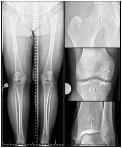 Femur Anatomy Xray