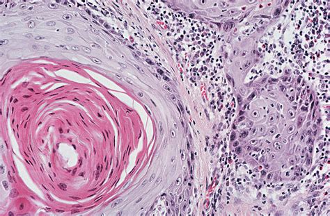 Keytruda Approved for Locally Advanced Cutaneous Squamous Cell Carcinoma